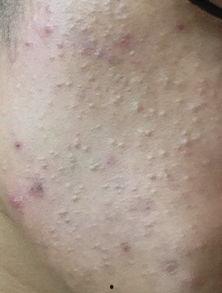 脸上长痣可以吃茭瓜吗,健康饮食与美丽肌肤的完美结合